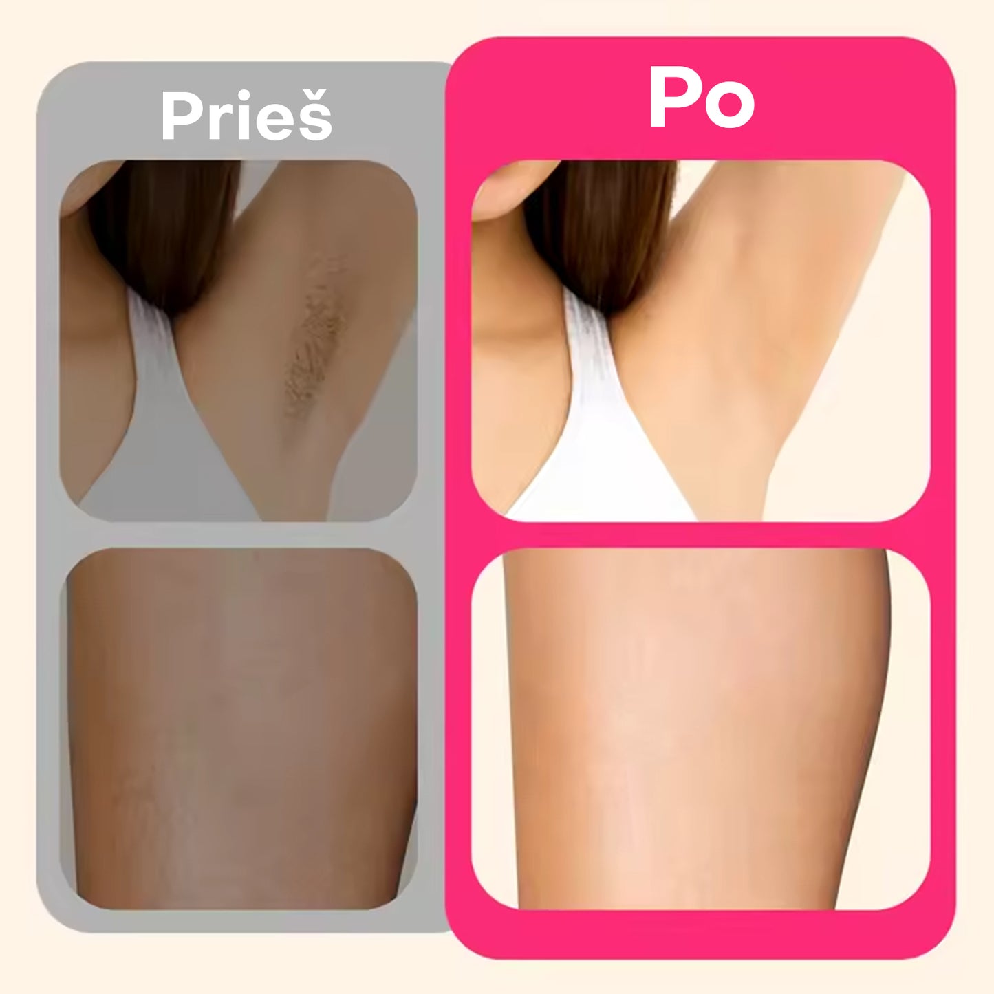 Lunero™ Plaukelių Šalinimas